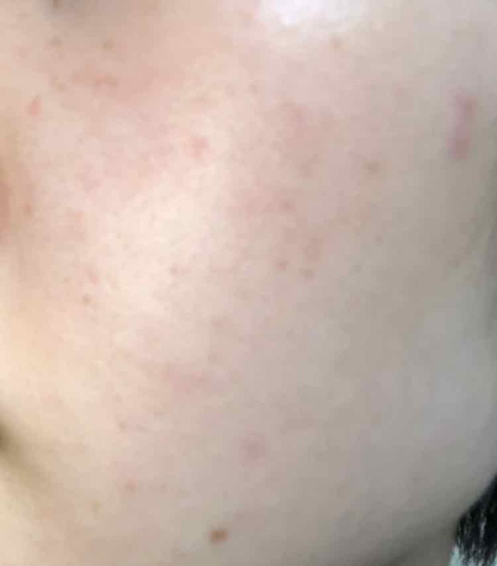 セラミドスキンケア 薬用アクネVCクリームジェル/エトヴォス/フェイスクリームを使ったクチコミ(2枚目)