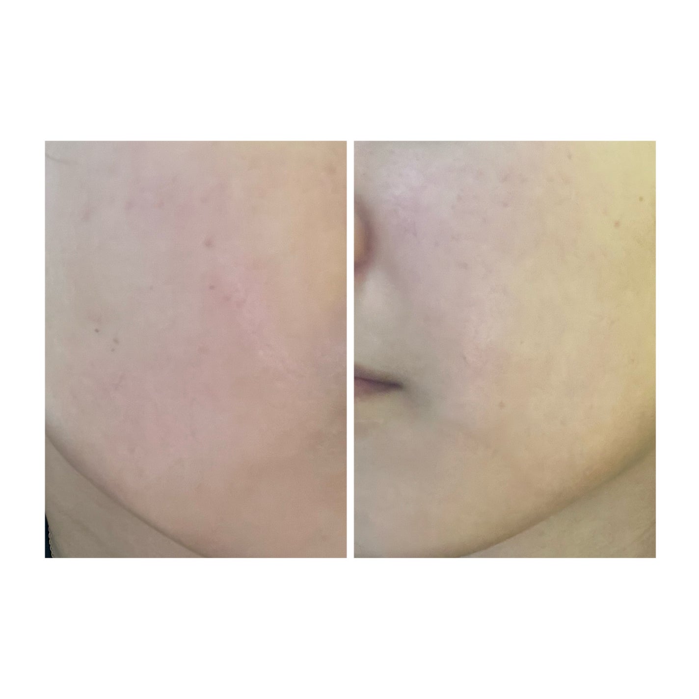 ぽむ on LIPS 「2023.9.13皮膚科に受診 エピデュオとヘパリン処方1枚目..」(2枚目)