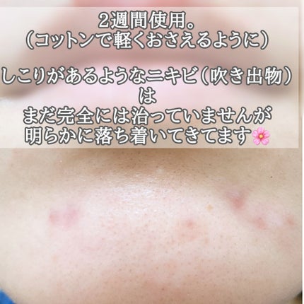 マキロン アクネージュ メディカルローション (医薬品)/マキロン/その他を使ったクチコミ(4枚目)