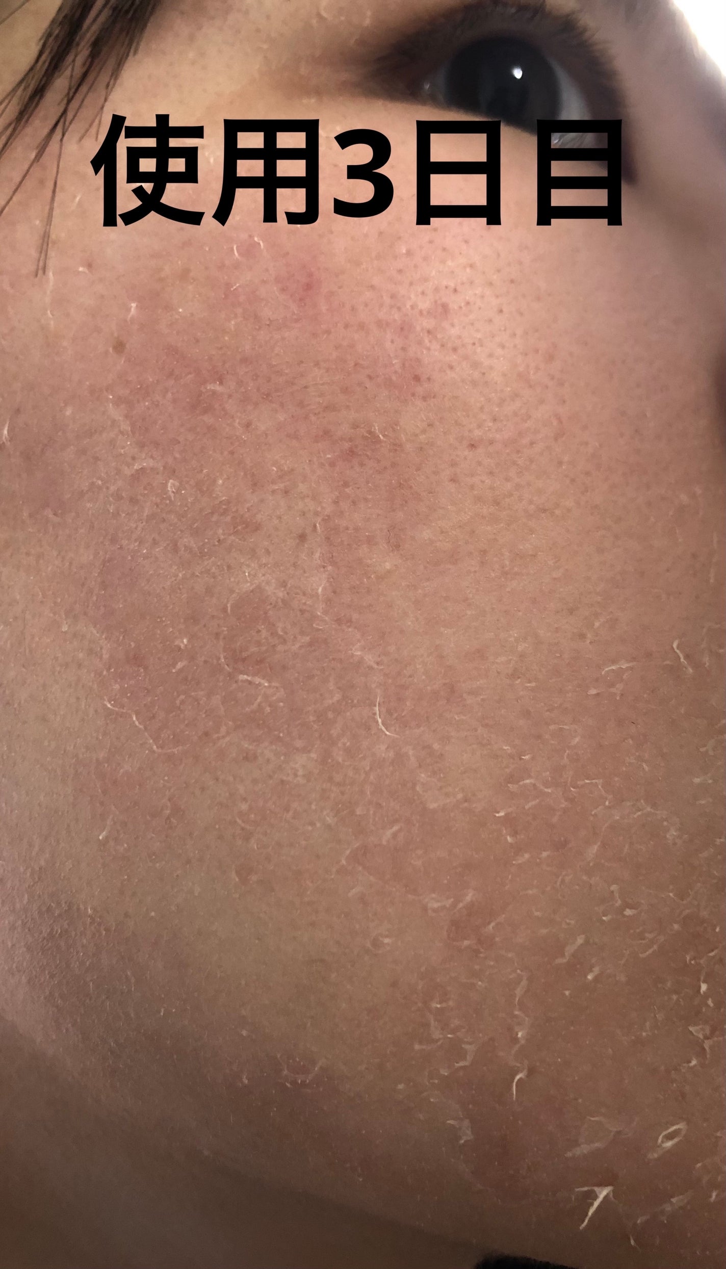 レチノールA 1% アドバンスドリバイタリゼーションクリーム/Life-flo/フェイスクリームを使ったクチコミ(5枚目)