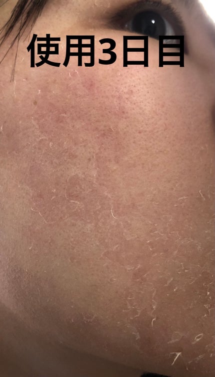 レチノールA 1% アドバンスドリバイタリゼーションクリーム/Life-flo/フェイスクリームを使ったクチコミ(5枚目)