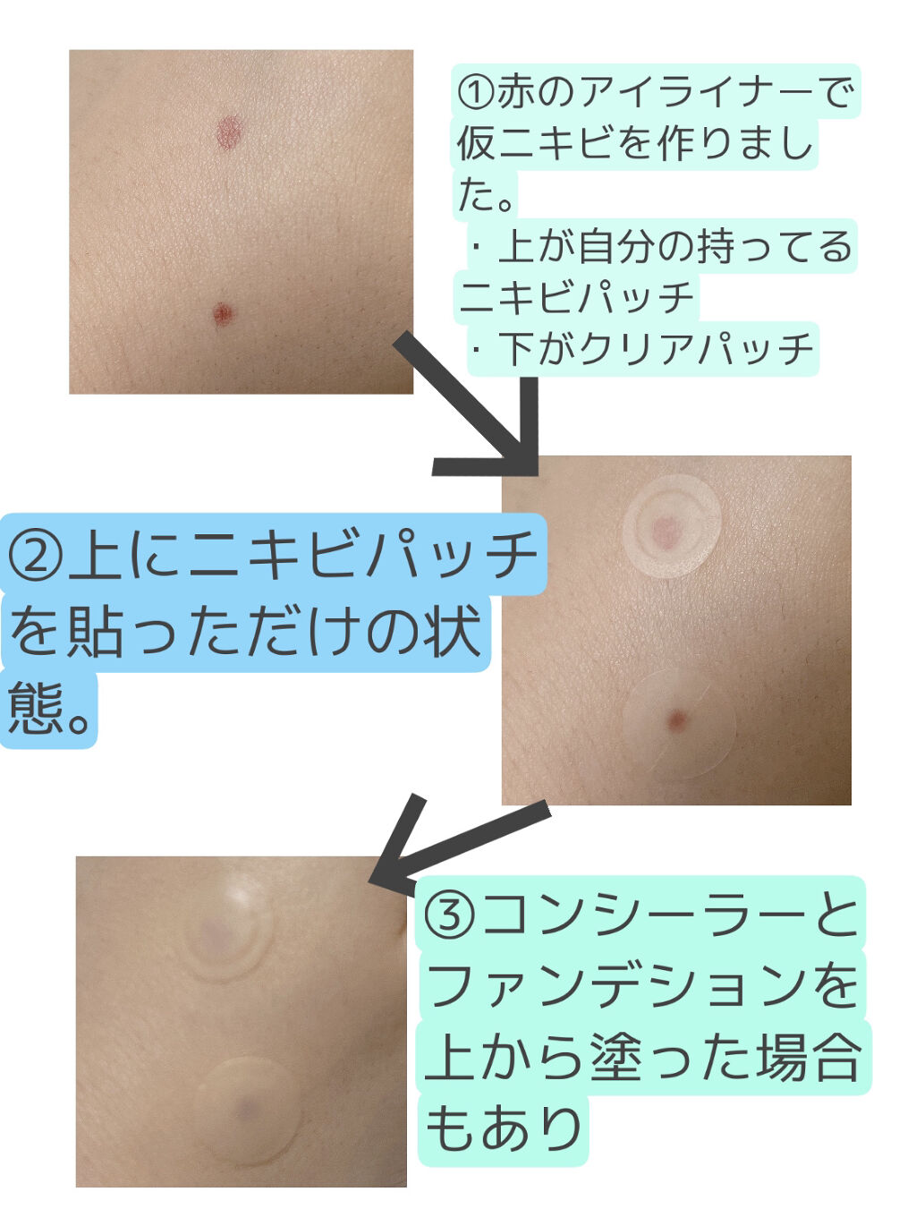 クリアパッチ/Angelab/にきびパッチを使ったクチコミ（3枚目）