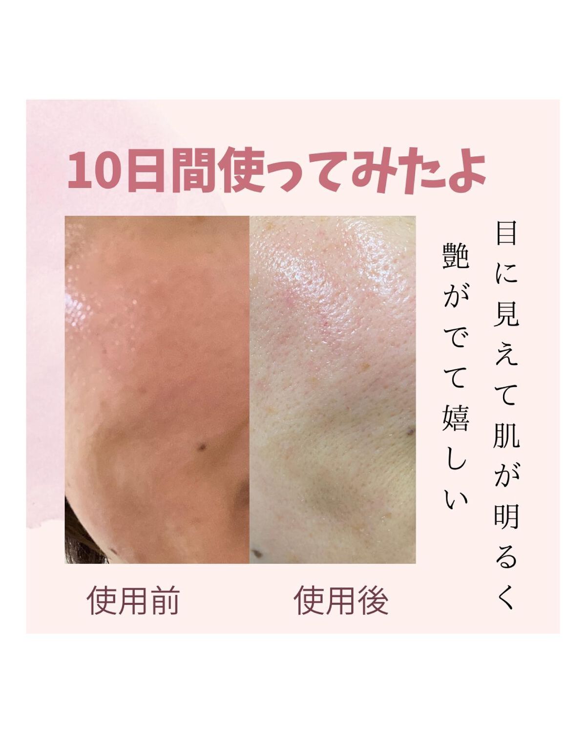 シカレチA エッセンス0.1/VT/美容液を使ったクチコミ(5枚目)