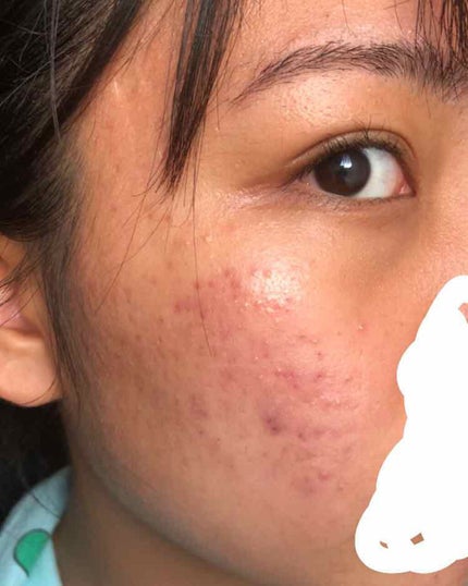 マスキング レイアリング アンプル エクセルトーニングショット/MEDIHEAL/美容液を使ったクチコミ(2枚目)