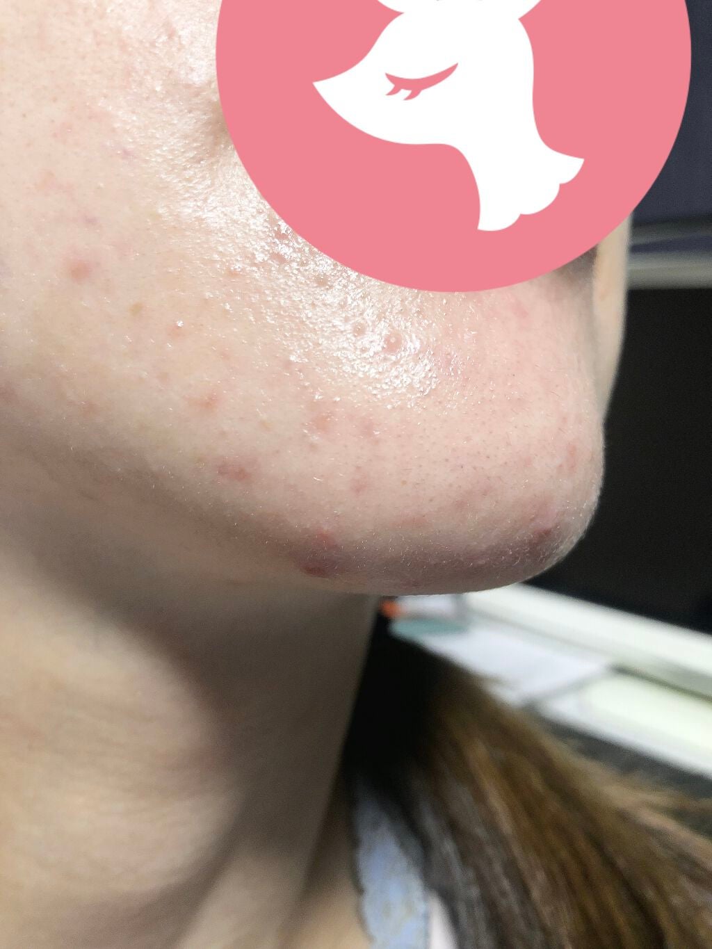 DRX AZAクリア/ロート製薬/その他スキンケアを使ったクチコミ(3枚目)