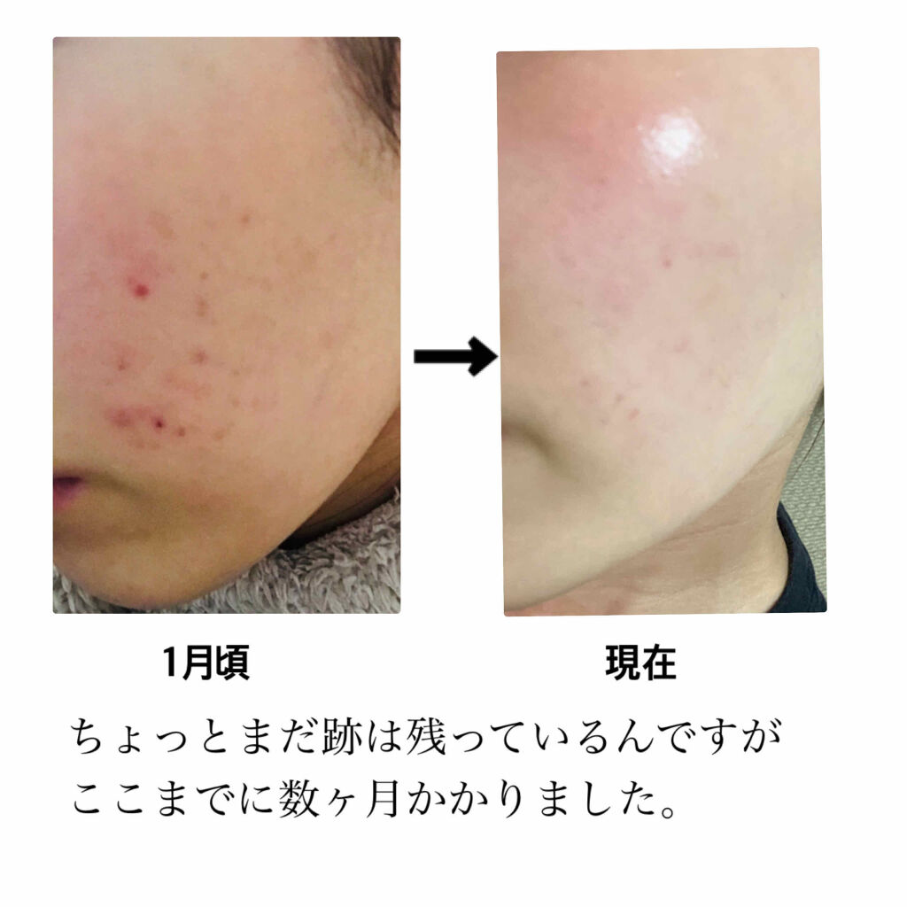 エクスパート パーフェクト フィット ファンデーション/VDL/リキッドファンデーションを使ったクチコミ（1枚目）