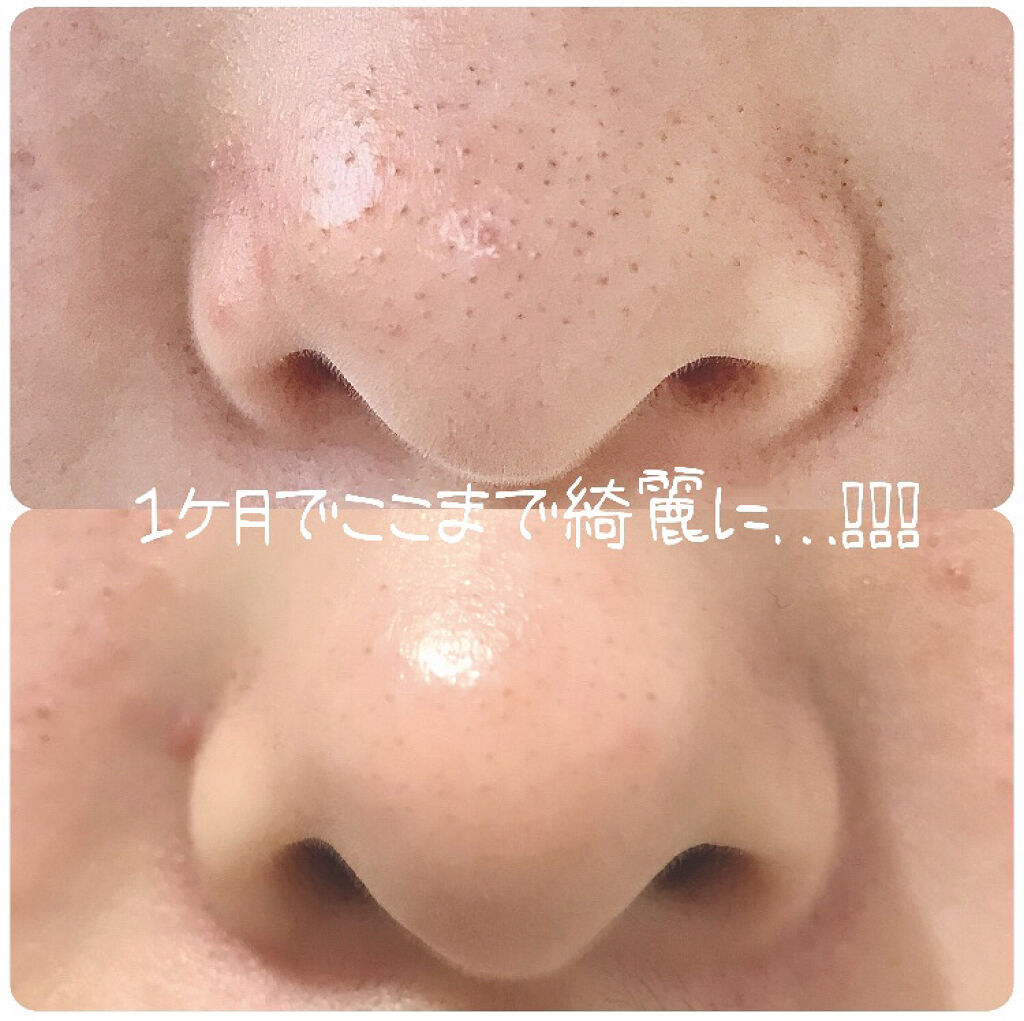 ホホバオイル 無印良品の口コミ いちご鼻で悩んでいる人必見 今回は1ヶ月 By ゆたぬ 混合肌 10代後半 Lips