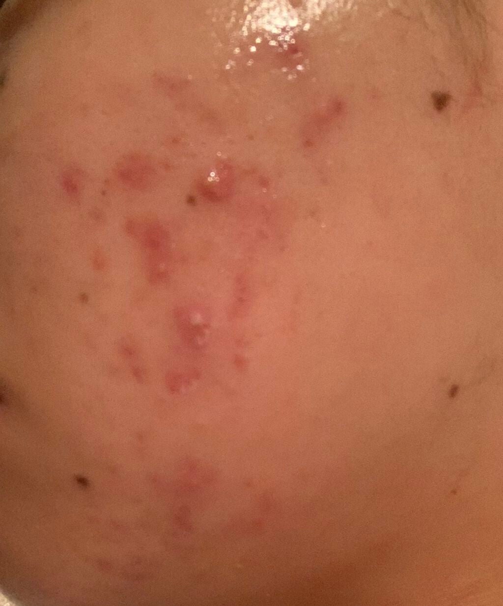 とろり on LIPS 「あけましておめでとうございます!!ニキビに年越しを許可した覚え..」(1枚目)