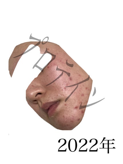 プロテイン on LIPS 「【自分用メモ】肌荒れでしんどい時読めいつかの私ほら!過去からこ..」(5枚目)