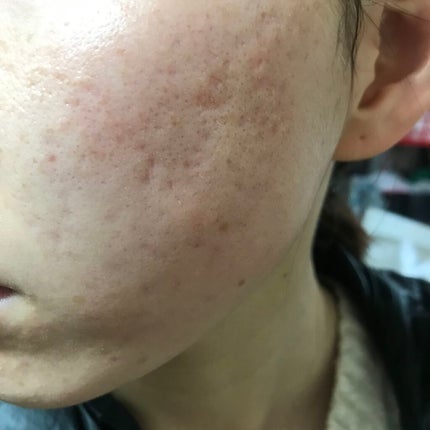 ティーツリーケア ソリューション エッセンシャルマスクEX/MEDIHEAL/シートマスク・パックを使ったクチコミ(2枚目)