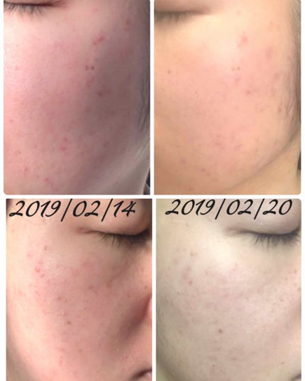 クリアトライアルセット M(しっとりタイプ)/オルビス/トライアルキットを使ったクチコミ(4枚目)