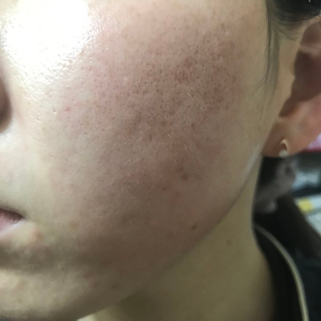 ティーツリーケア ソリューション エッセンシャルマスクEX/MEDIHEAL/シートマスク・パックを使ったクチコミ(2枚目)