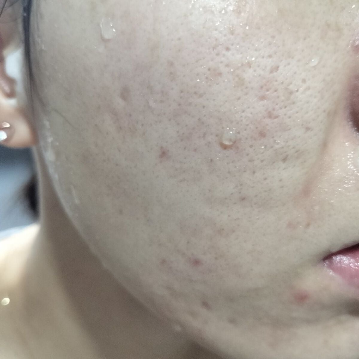 miina@汚肌工事録⚠️ on LIPS 「10/21の#汚肌工事録ん?この日は割とマシ。でも日本にいたと..」(1枚目)