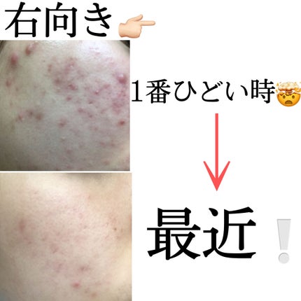 ハトムギ化粧水(ナチュリエ スキンコンディショナー R )/ナチュリエ/化粧水を使ったクチコミ(5枚目)