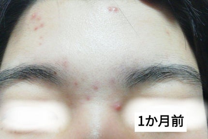 ロゼット洗顔パスタ アクネクリア/ロゼット/洗顔フォームを使ったクチコミ(2枚目)