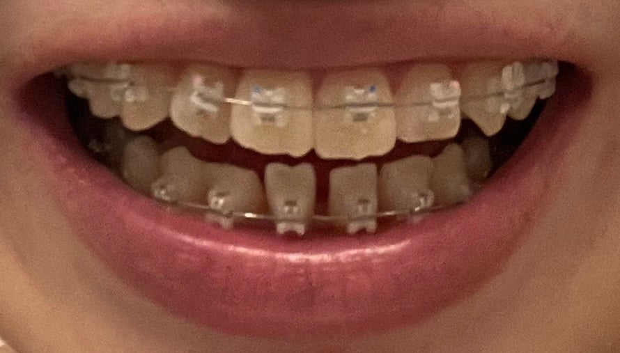 ハナ on LIPS 「上顎もワイヤー付きました!下顎はワイヤー交換してもらいました!..」(3枚目)