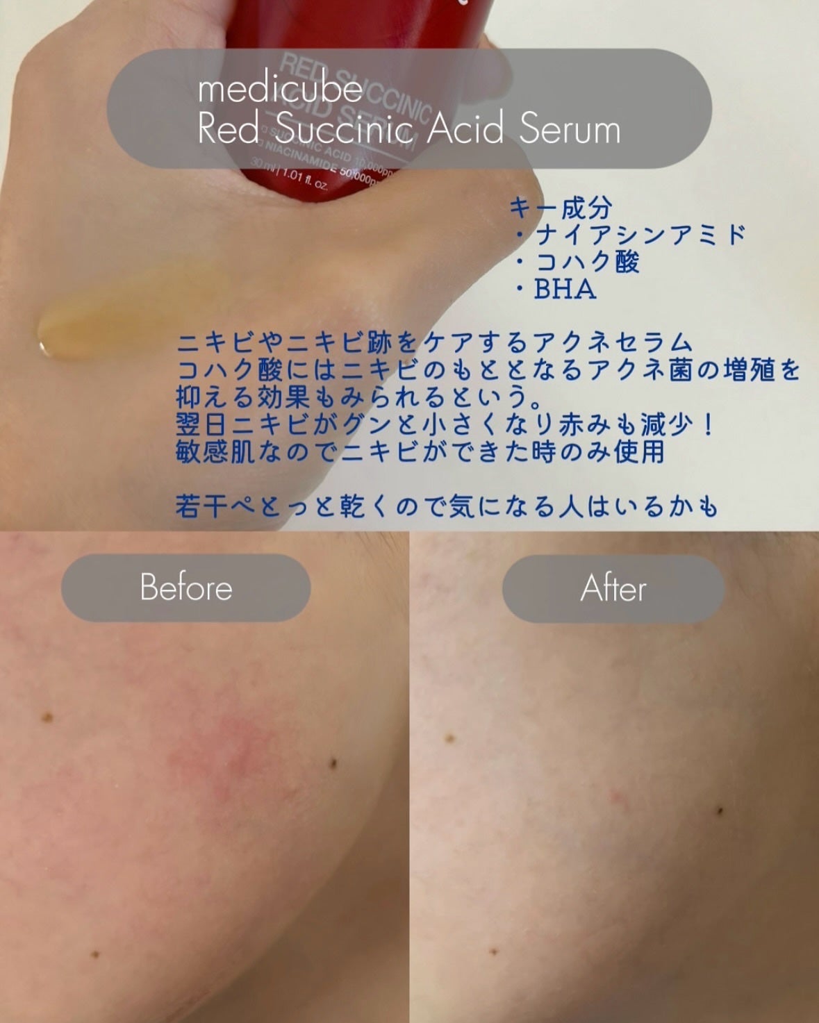 レッドアクネセラム/MEDICUBE/美容液を使ったクチコミ(3枚目)