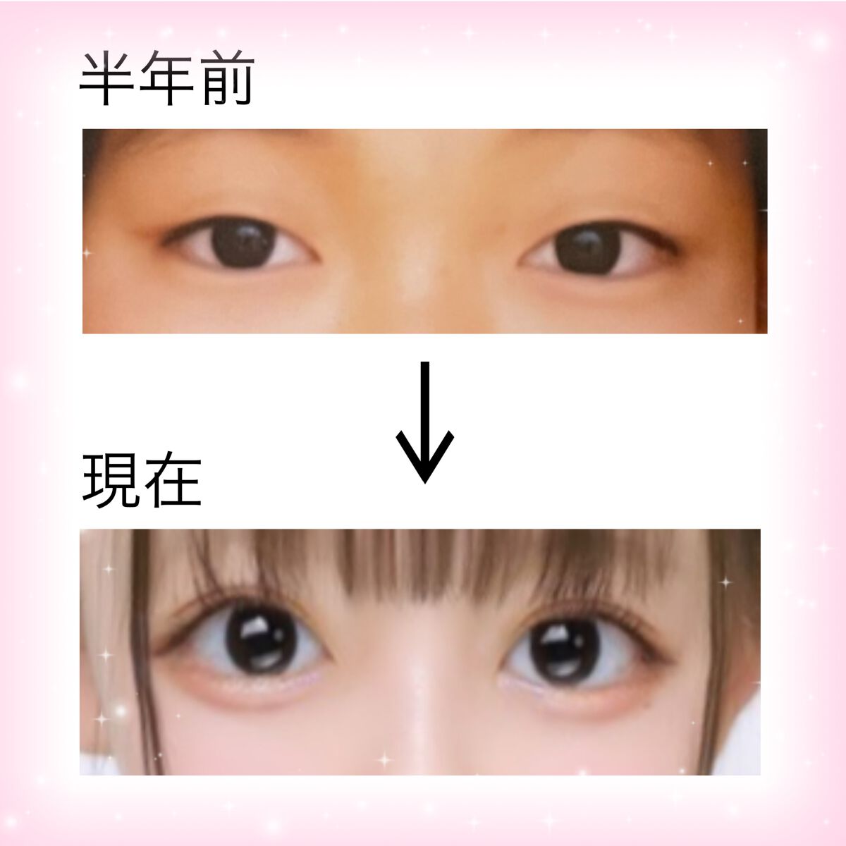 のびーるアイテープ（絆創膏タイプ、レギュラー）/DAISO/二重まぶた用アイテムを使ったクチコミ（2枚目）