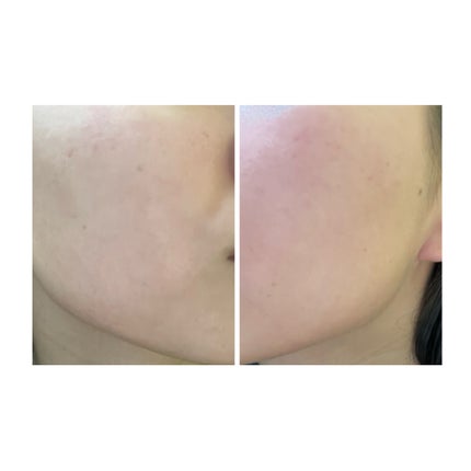 ぽむ on LIPS 「2023.9.13皮膚科に受診 エピデュオとヘパリン処方1枚目..」(5枚目)