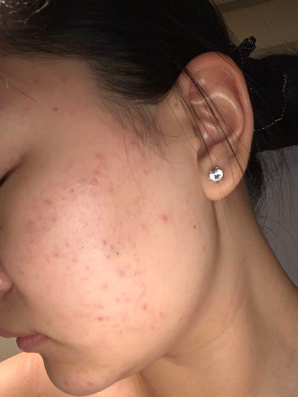 ティーツリーケア ソリューション エッセンシャルマスクEX/MEDIHEAL/シートマスク・パックを使ったクチコミ(3枚目)