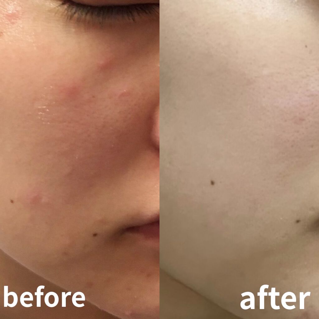 オロナインＨ軟膏 (医薬品)/オロナイン/その他を使ったクチコミ（1枚目）