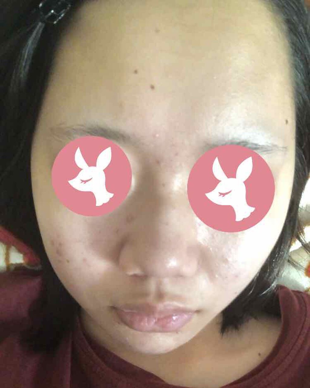 ふりすく on LIPS 「3日目の肌です!!鼻左横のニキビ1つはほぼ治りニキビ跡っぽくな..」(2枚目)