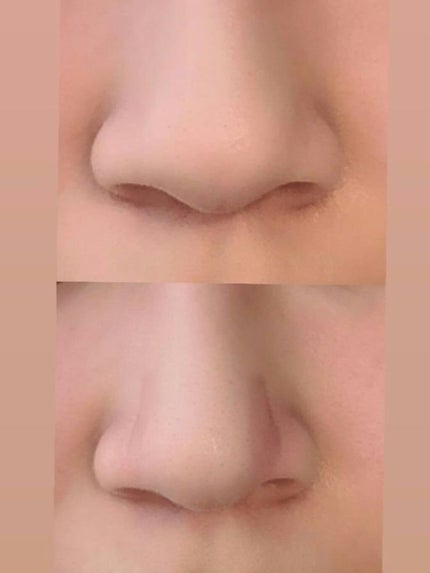 お鼻リフォーマー ハナハナ/グッズマン/その他を使ったクチコミ(1枚目)