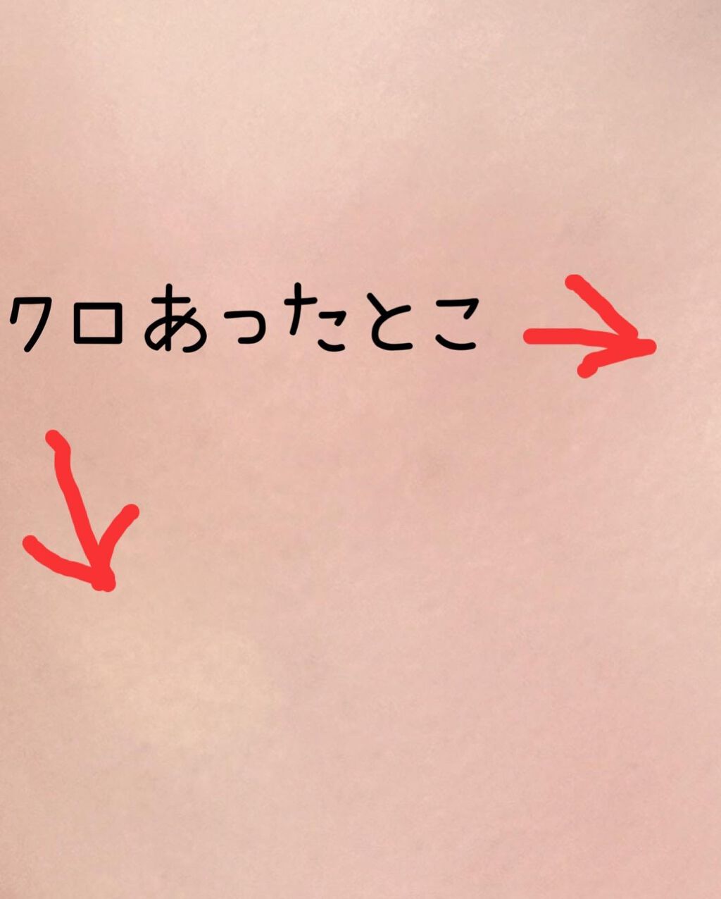 タトゥーウォータープルーフスカーコンシーラー/フォレンコス/リキッドコンシーラーを使ったクチコミ(5枚目)