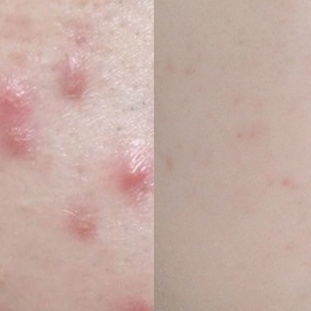 薬用しみ対策美白ジェル/メラノCC/フェイスクリームを使ったクチコミ（2枚目）