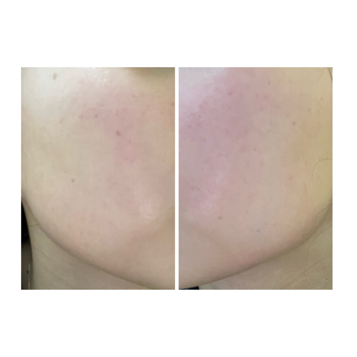 ぽむ on LIPS 「2023.9.13皮膚科に受診 エピデュオとヘパリン処方1枚目..」(1枚目)