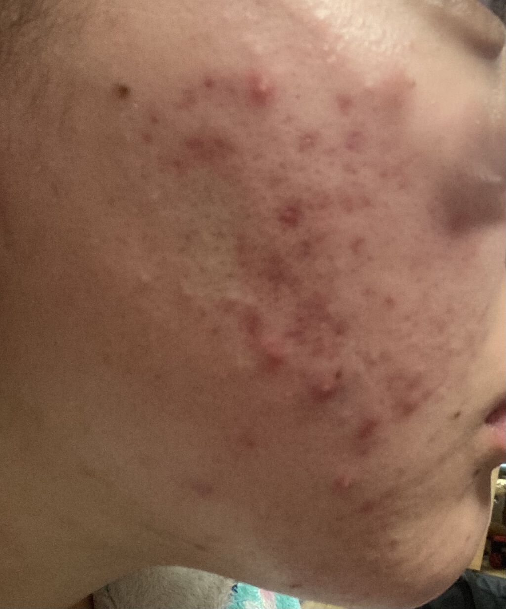 クリンダマイシンゲル(医薬品)/クラシエ薬品/その他を使ったクチコミ（2枚目）