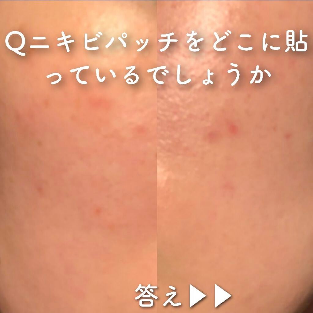 A-zero Shot スキンドレッシングパッチ/MEDIHEAL/シートマスク・パックを使ったクチコミ(1枚目)