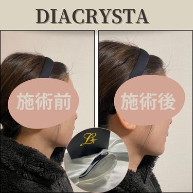 diacrysta diacrysta　美顔器のクチコミ「【DIACRYSTA】

☑︎カッサ型の美顔器

3つの機能があり、ホームケアの質が上がる♡
.....」（3枚目）