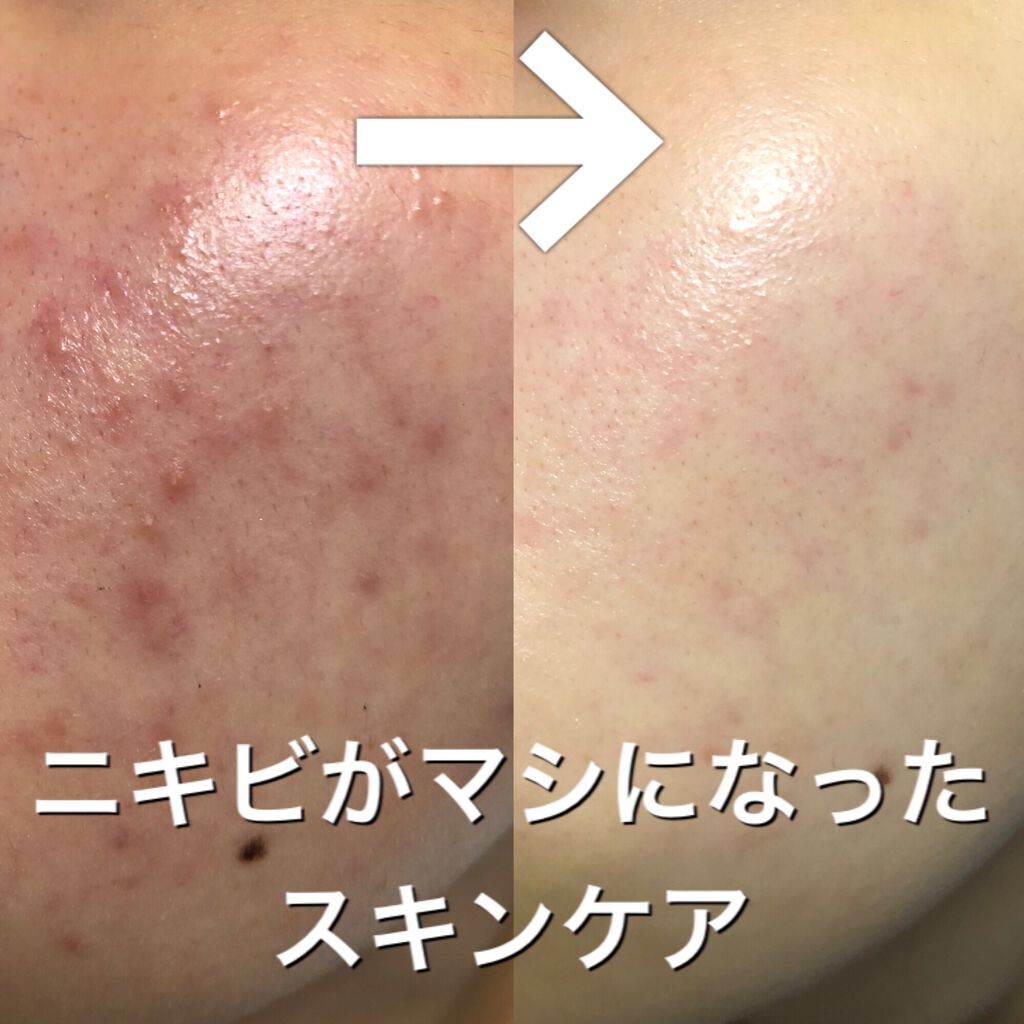 クレンジングバームモイストN/CLAYGE/クレンジングバームを使ったクチコミ（1枚目）