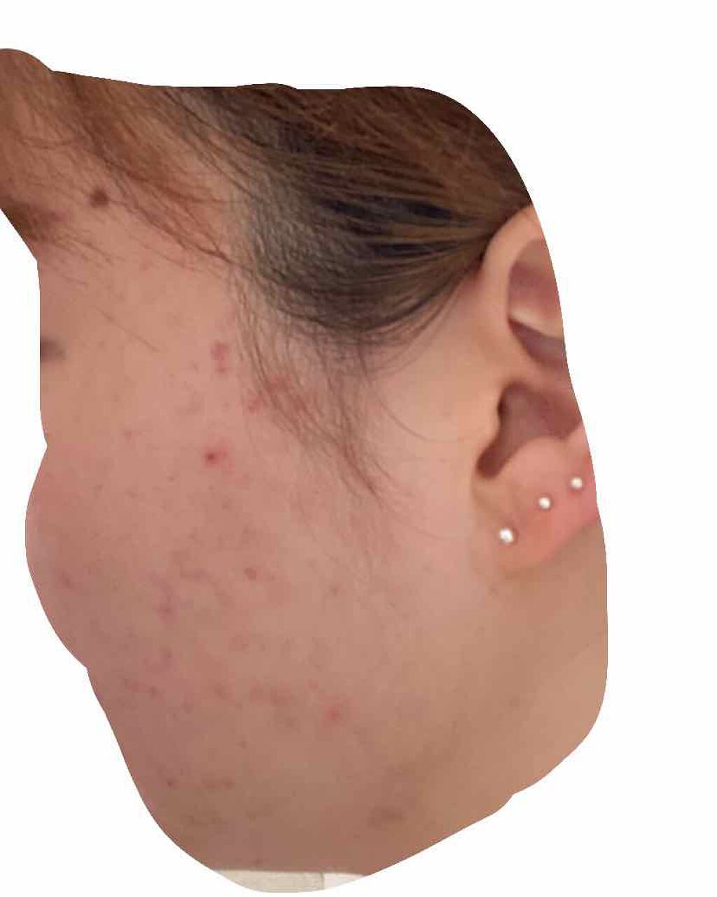 り on LIPS 「人生最大の肌荒れから3ヶ月経ちましたがまだまだ良くなりません😭..」(3枚目)