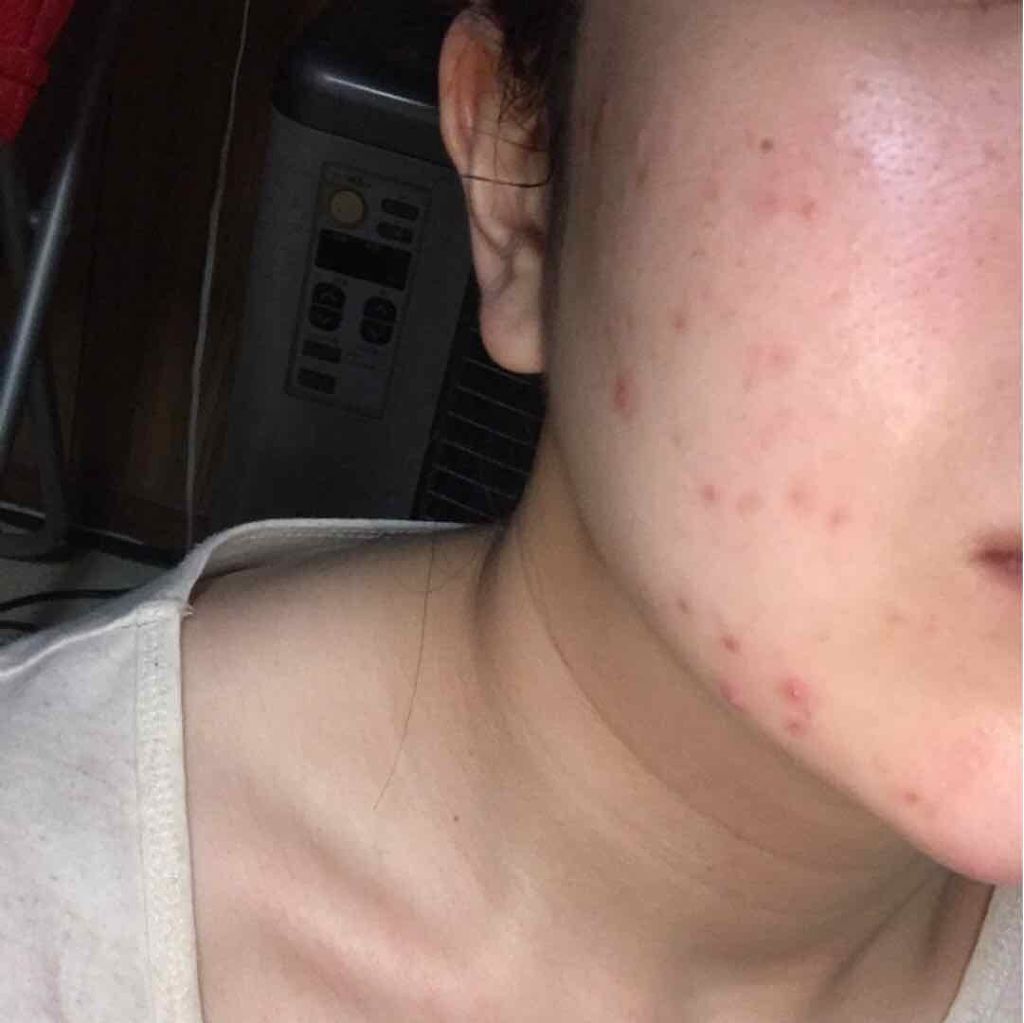 Rie❁❁ on LIPS 「ニキビの汚い画像あります。*閲覧注意です⚠️*ニキビ観察日記①..」(2枚目)