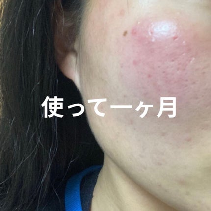 薬用しみ集中対策 プレミアム美容液/メラノCC/美容液を使ったクチコミ(4枚目)