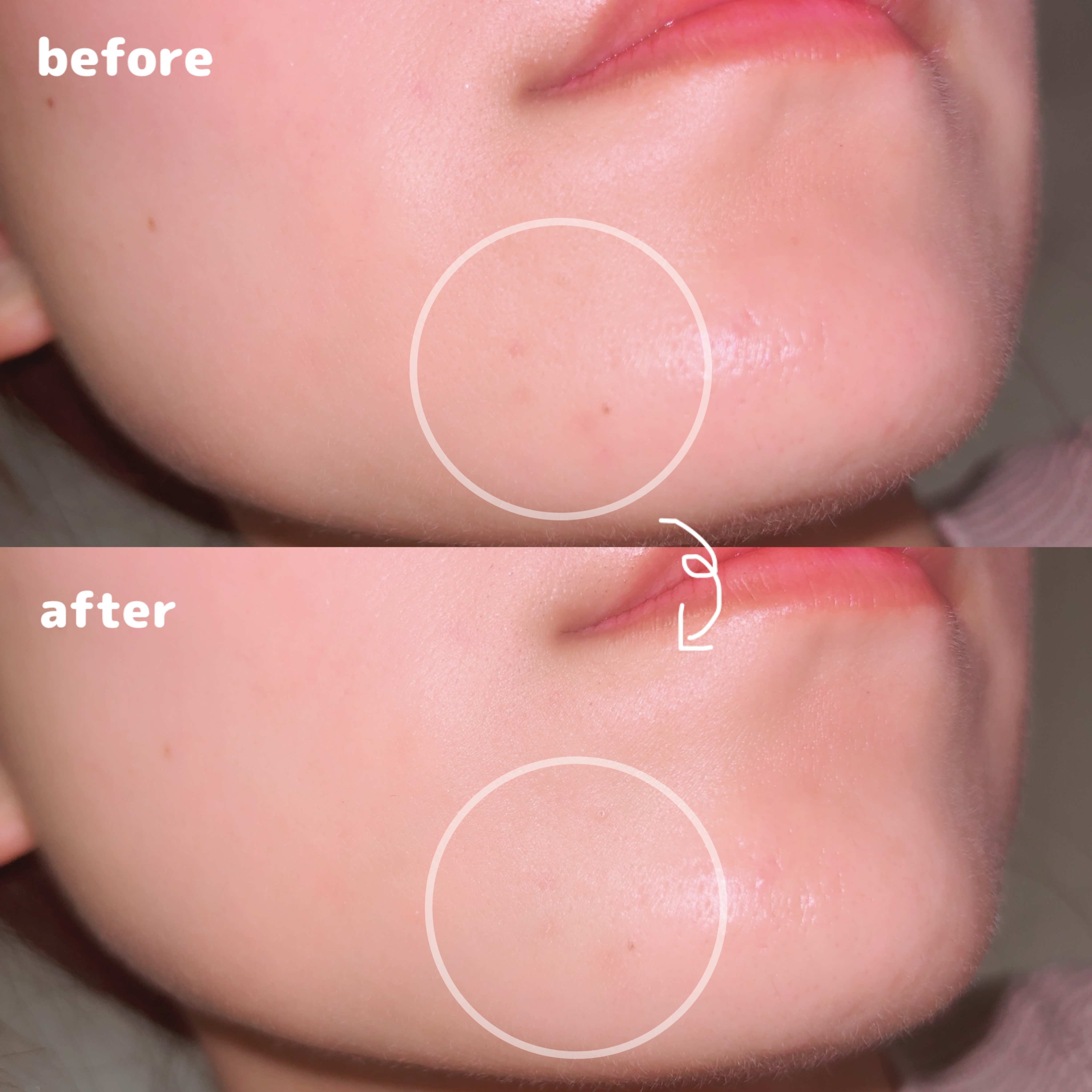 薬用スポットシーラークリーム/スキンヒーロー/クリームコンシーラーを使ったクチコミ（3枚目）