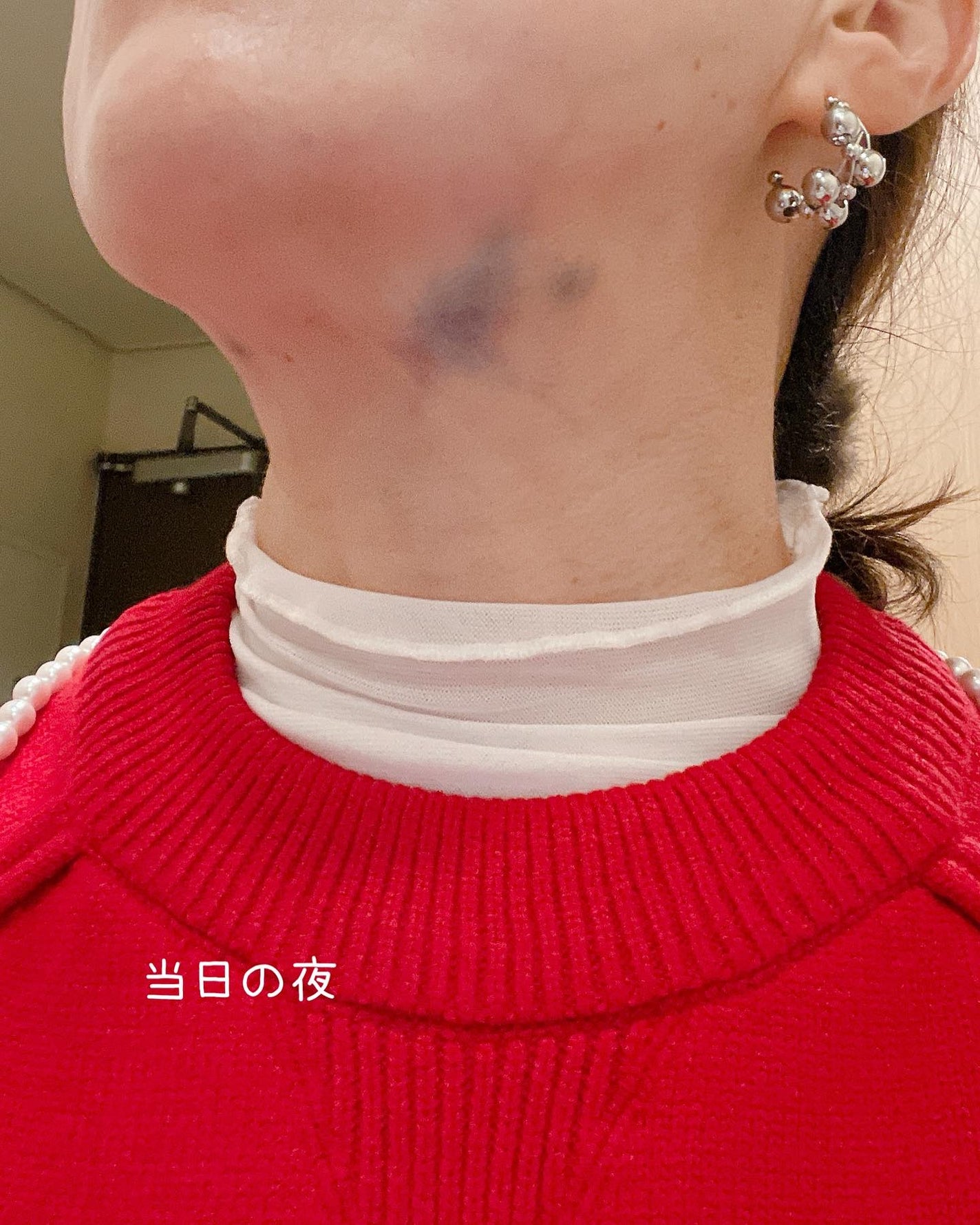 maru☻︎ on LIPS 「韓国で初めての美容施術を受けてきました🇰🇷♡︎特にフェイスライ..」(6枚目)