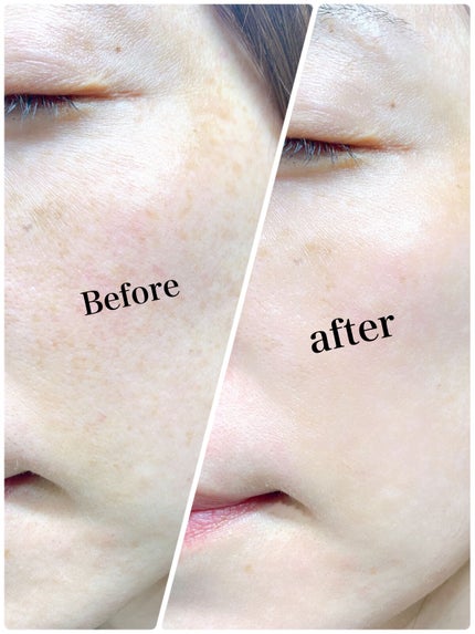 ニードル炭酸パック/NNE/洗い流すパック・マスクを使ったクチコミ(5枚目)