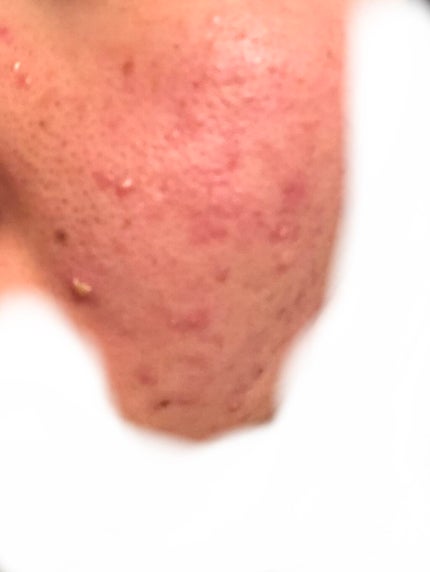 sparkle_lips_tgtn on LIPS 「初投稿です!いきなりですが、私のニキビの状態を見てください😭よ..」(4枚目)