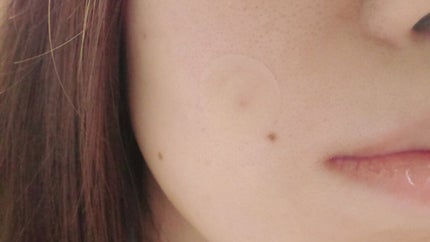 キズを早くきれいに治すパッチ/matsukiyo/その他を使ったクチコミ(4枚目)