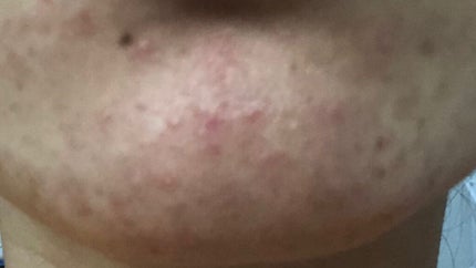 オードムーゲ 薬用ローション(ふきとり化粧水)/オードムーゲ/拭き取り化粧水を使ったクチコミ(5枚目)