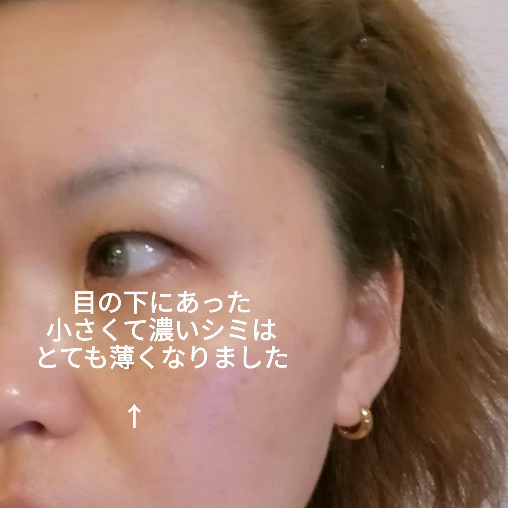 IPLフォトダブル/湘南美容/その他を使ったクチコミ（3枚目）