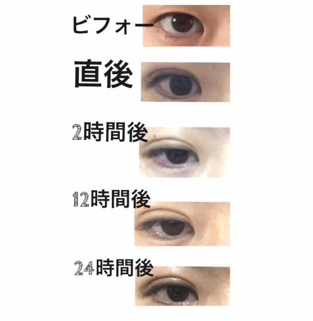 二重整形/その他を使ったクチコミ（2枚目）