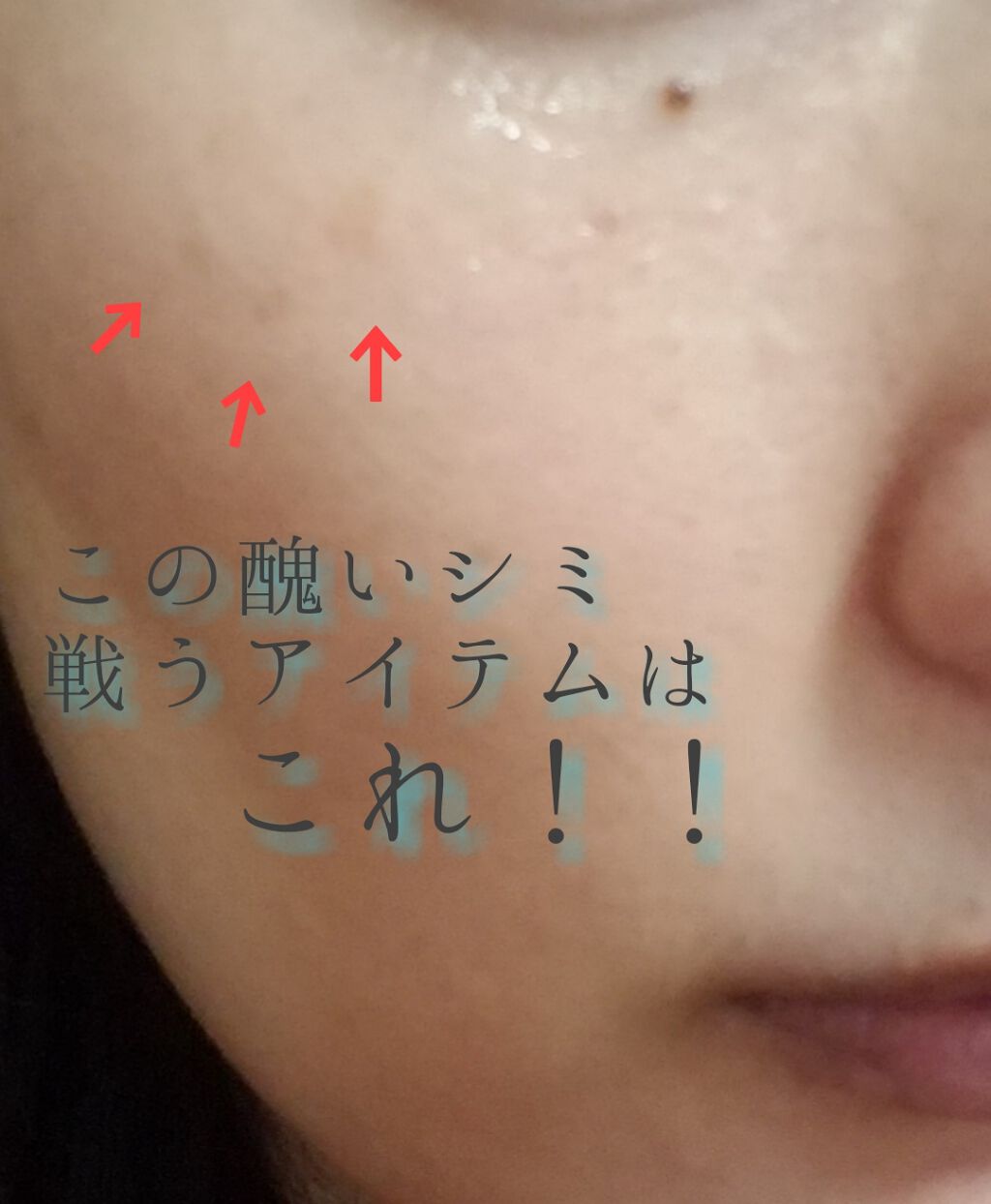 薬用 しみ 集中対策 美容液/メラノCC/美容液を使ったクチコミ(1枚目)