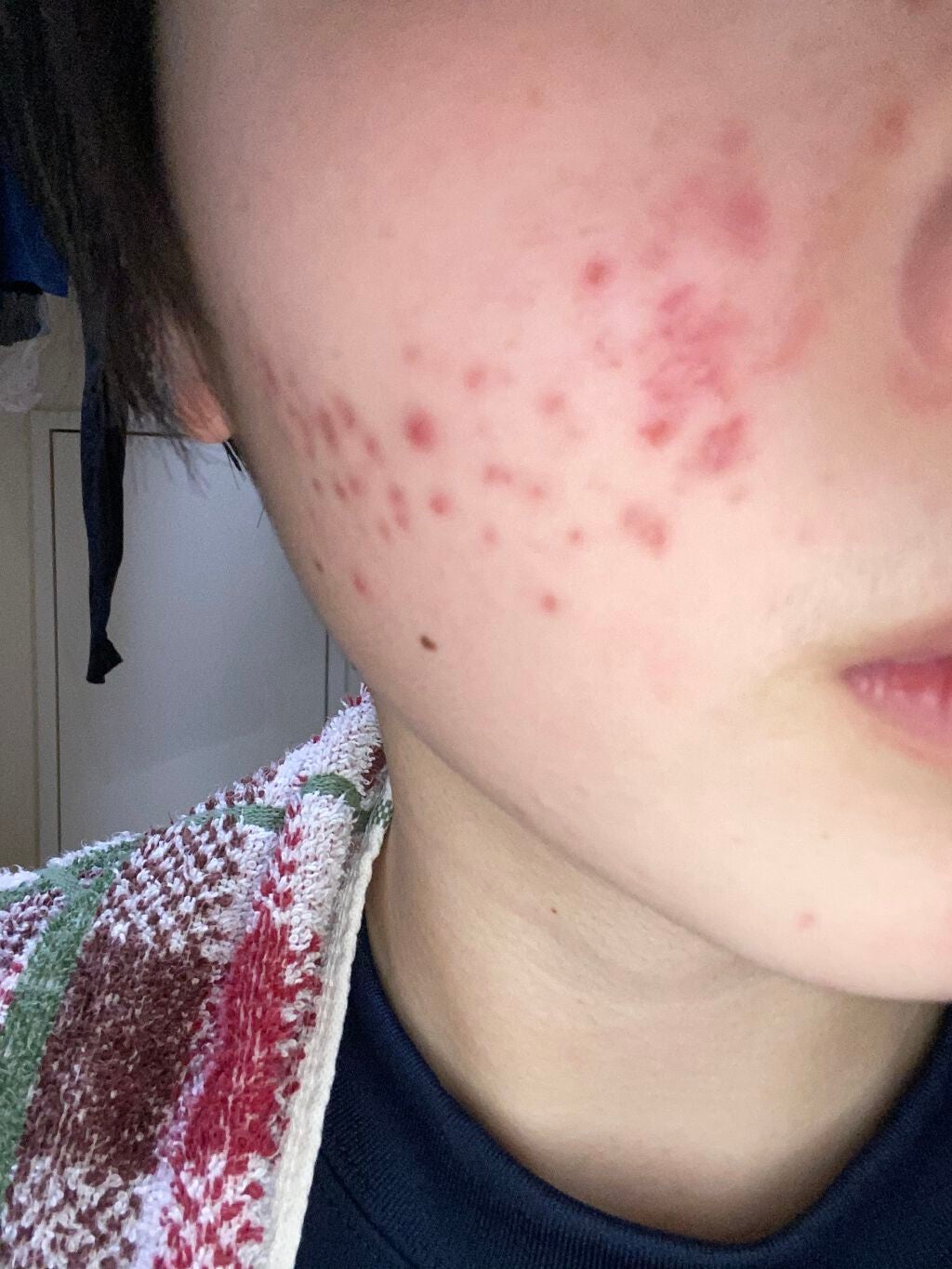 のの on LIPS 「約1ヶ月が経ちました。おでこは良くなってきてますがまだほっぺた..」(2枚目)