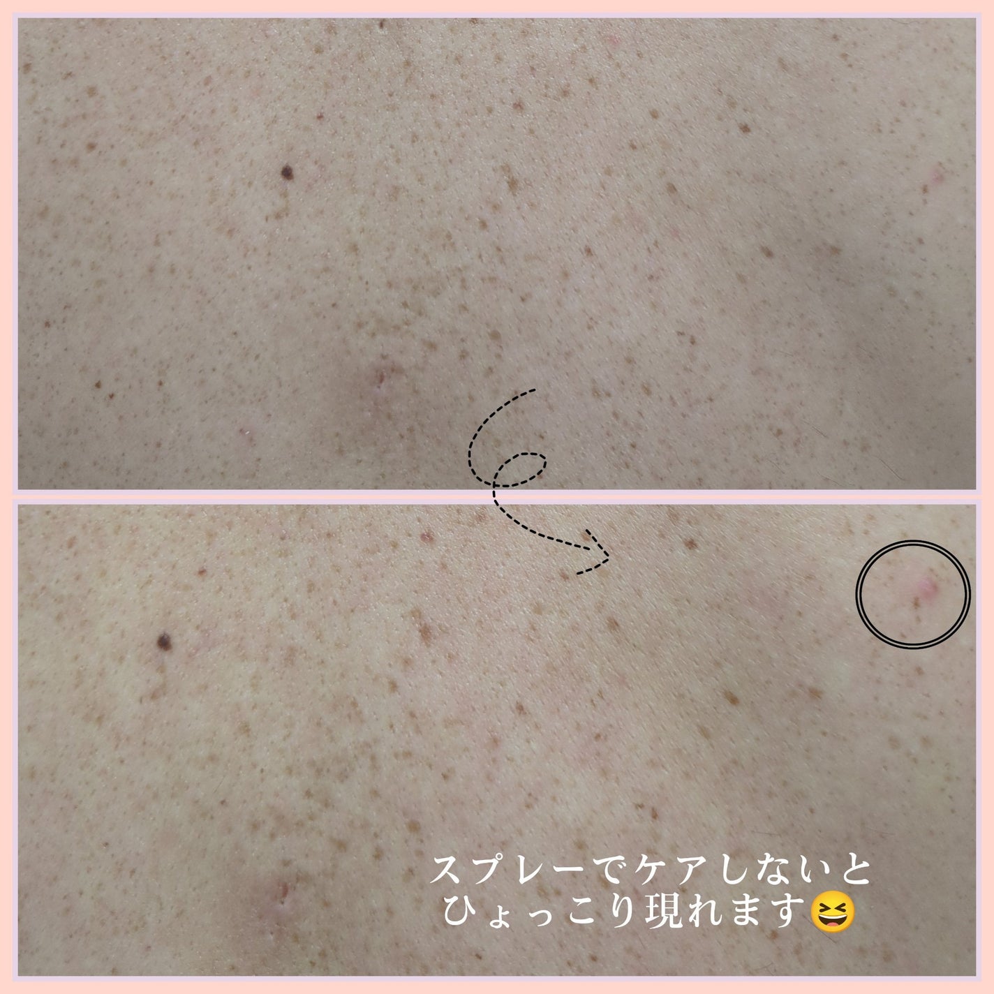 レッドアクネ ボディピーリングショット/MEDICUBE/ピーリングを使ったクチコミ(7枚目)