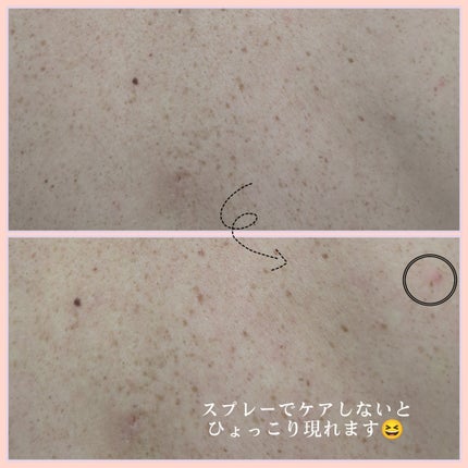 レッドアクネ ボディピーリングショット/MEDICUBE/ピーリングを使ったクチコミ(7枚目)