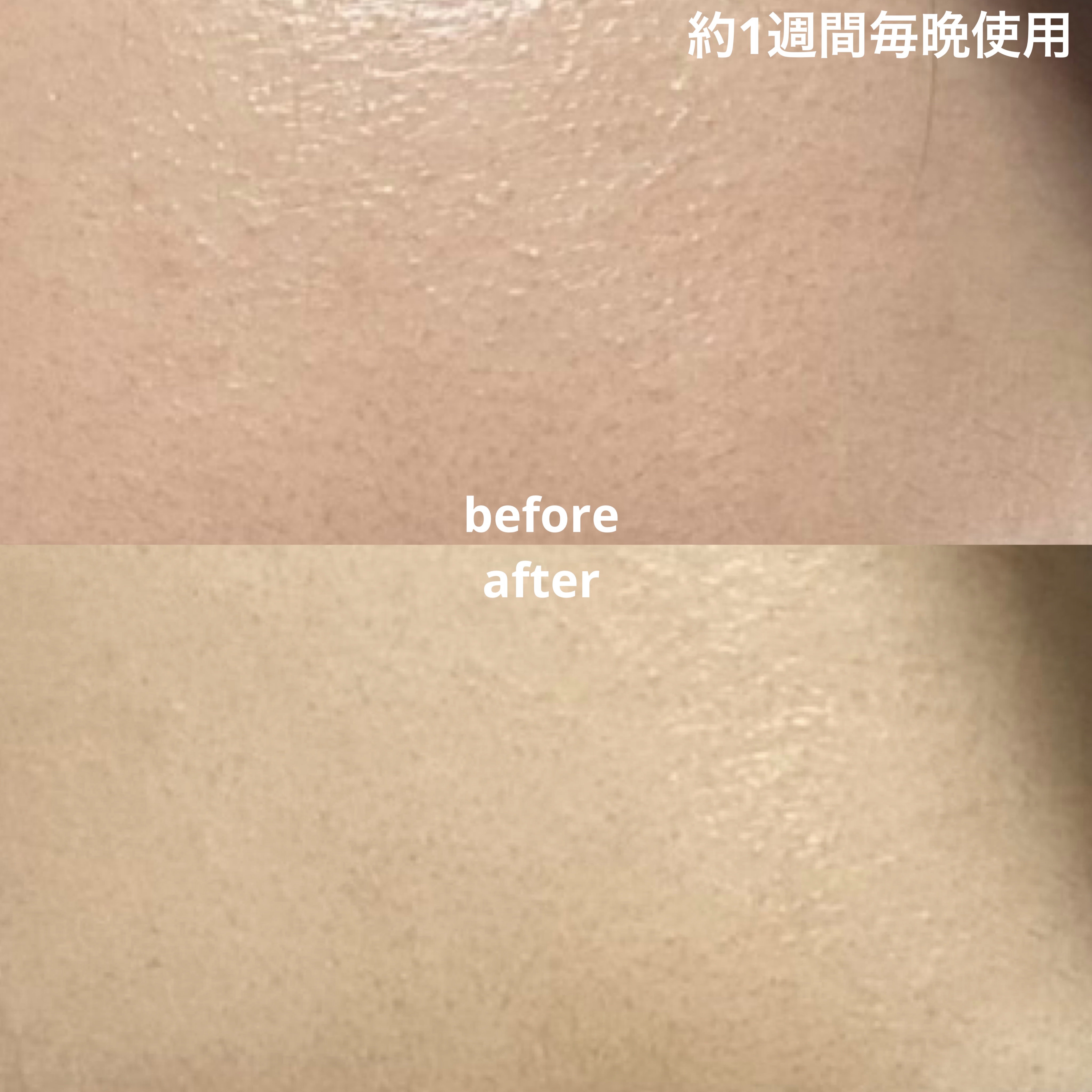 エーキュアショットスポットパッチ/obsero/にきびパッチを使ったクチコミ（3枚目）